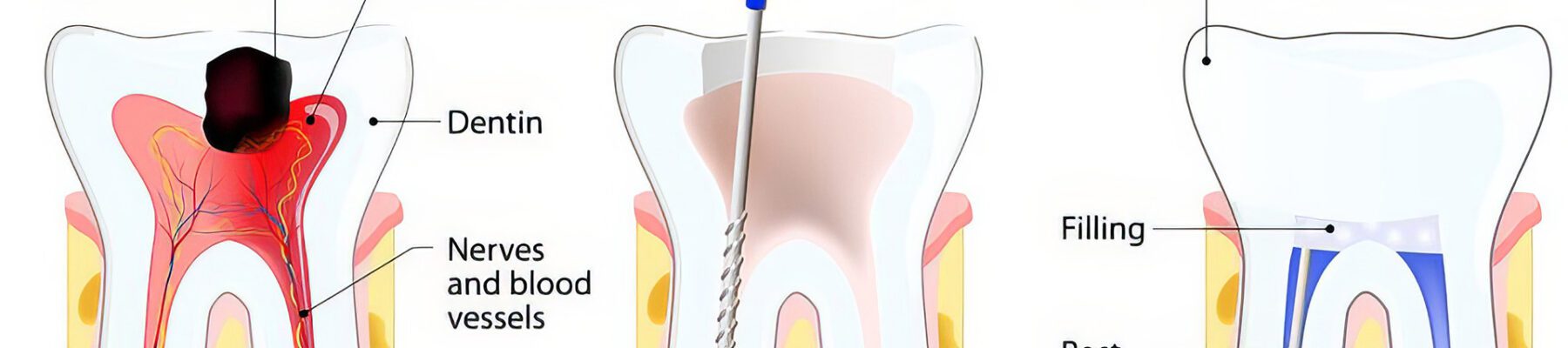 Root Canal Treatment Bishops Stortford
